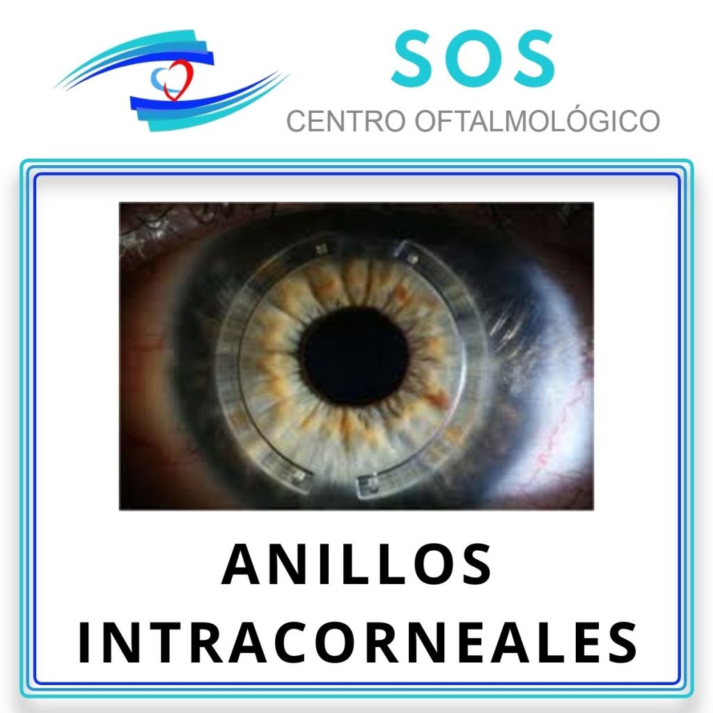 Anillos Intracorneales