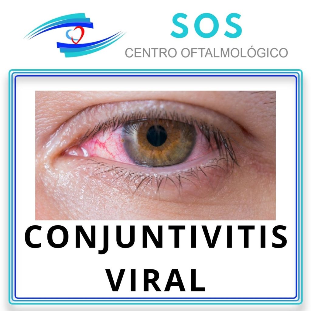 Conjuntivitis viral