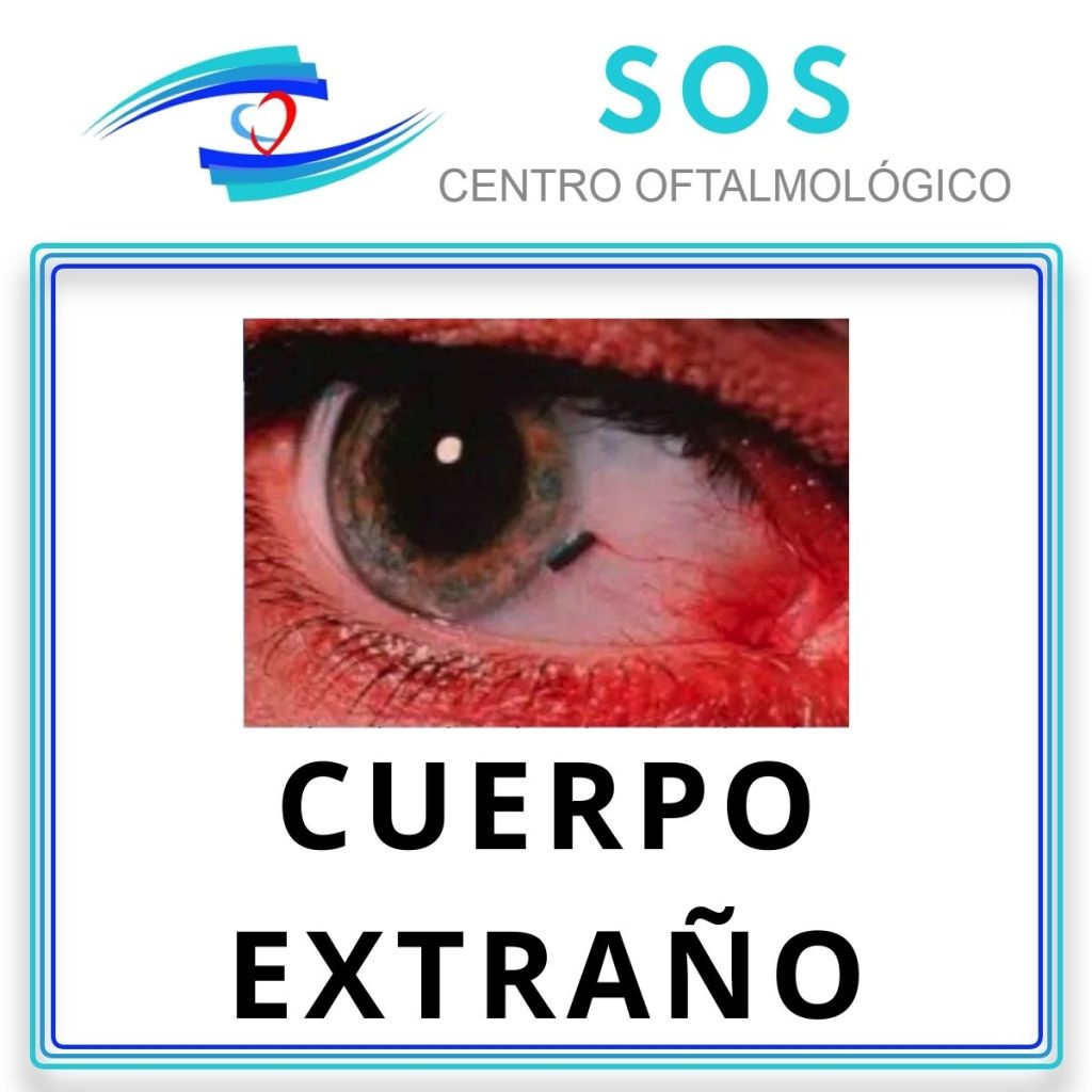 Cuerpo Extraño en el Ojo