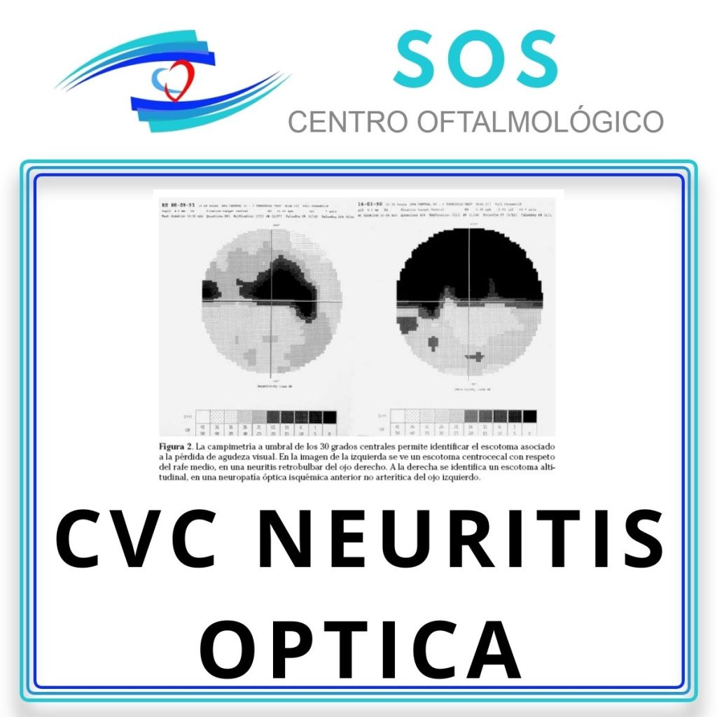 CVC Neuritis Óptica