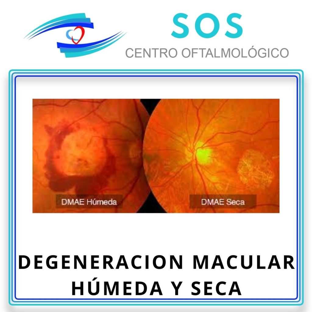 Degeneración Macular