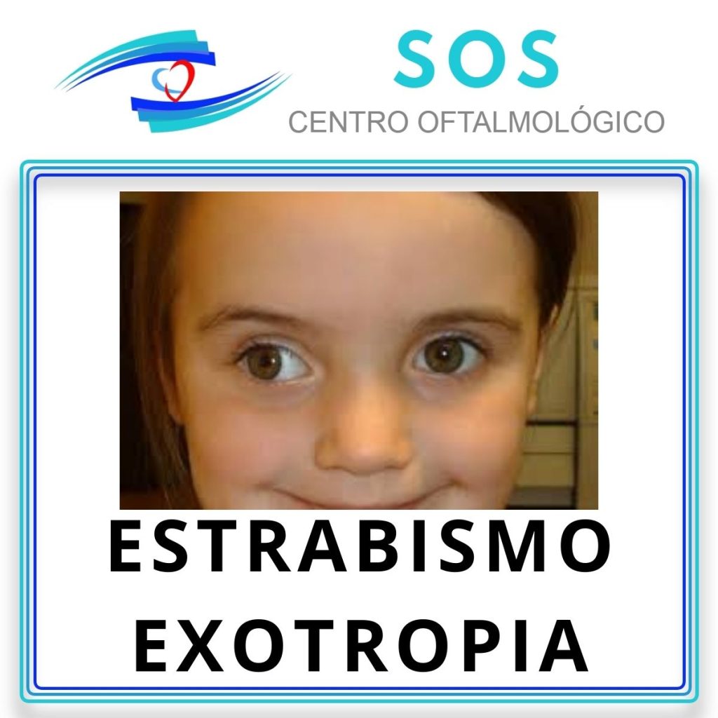 Estrabismo Exotropía