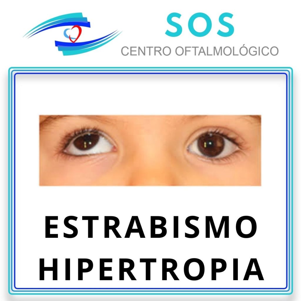 Estrabismo hipertropia