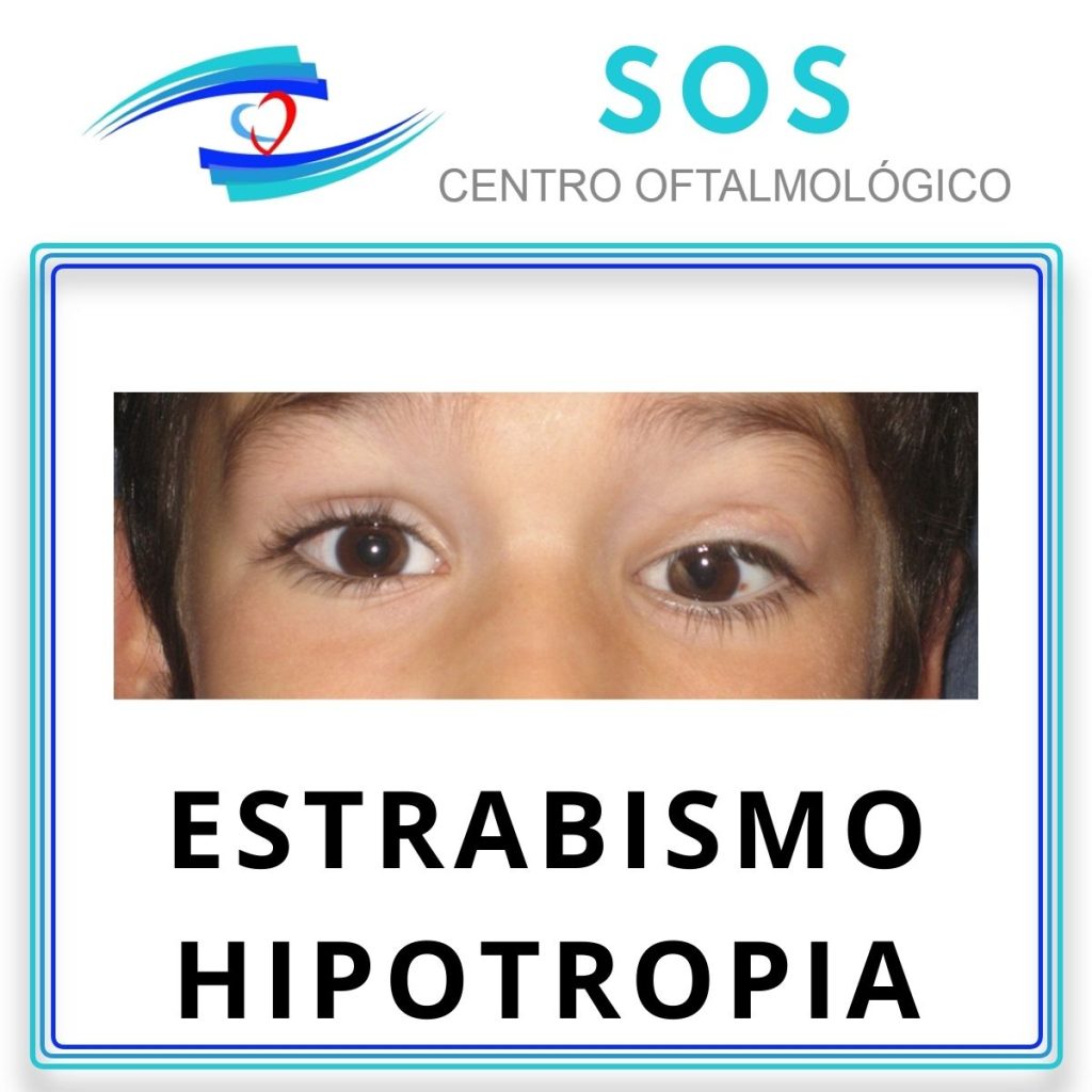 Estrabismo hipotropia