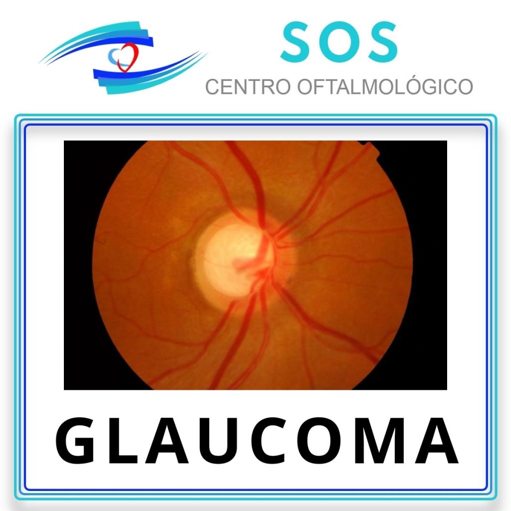 Glaucoma