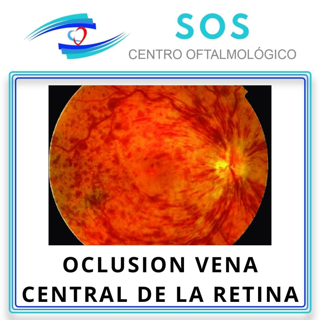 Oclusión de la vena central de la retina