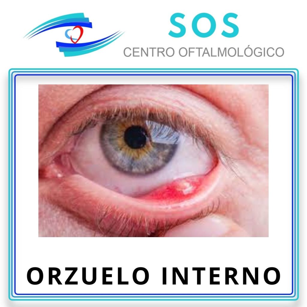 Orzuelo interno