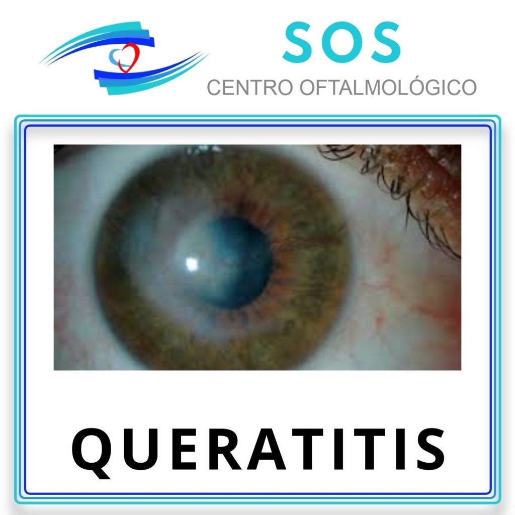 Queratitis