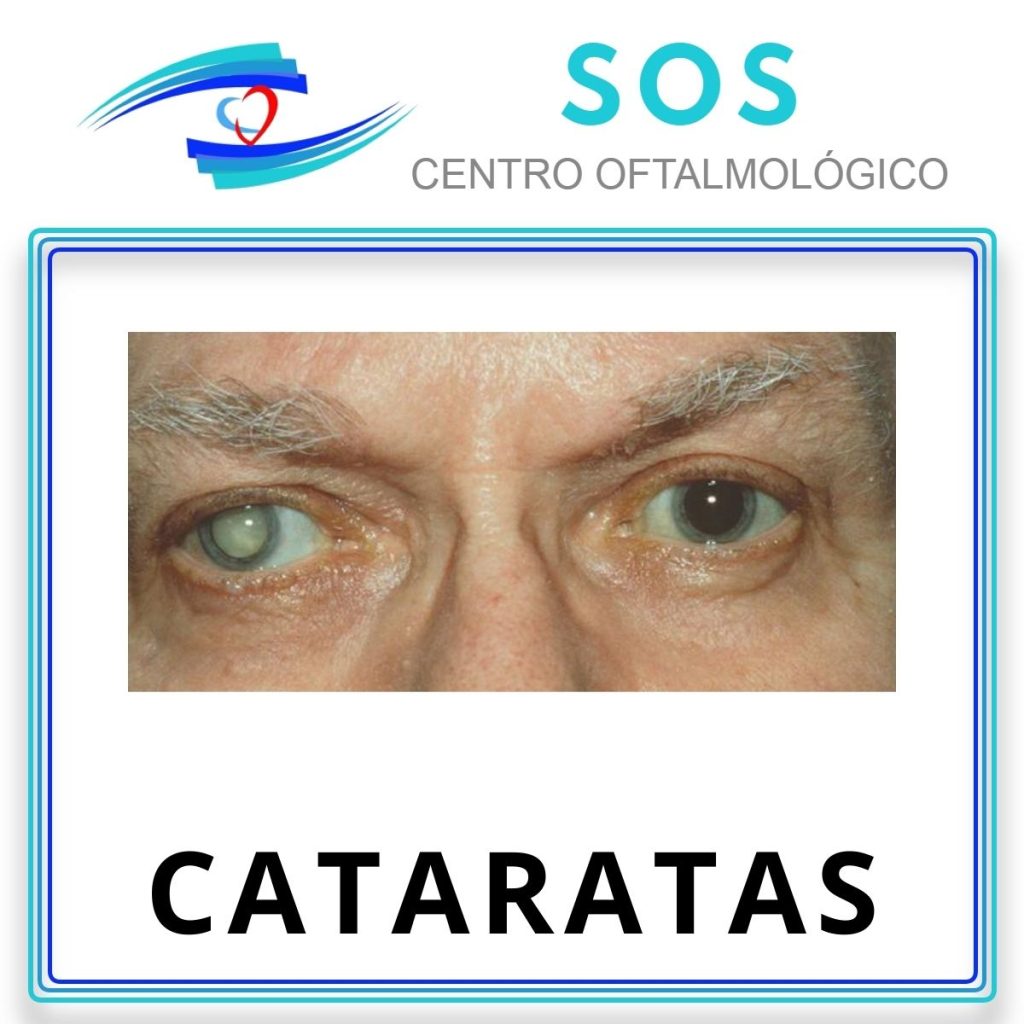 Cataratas Ocular 