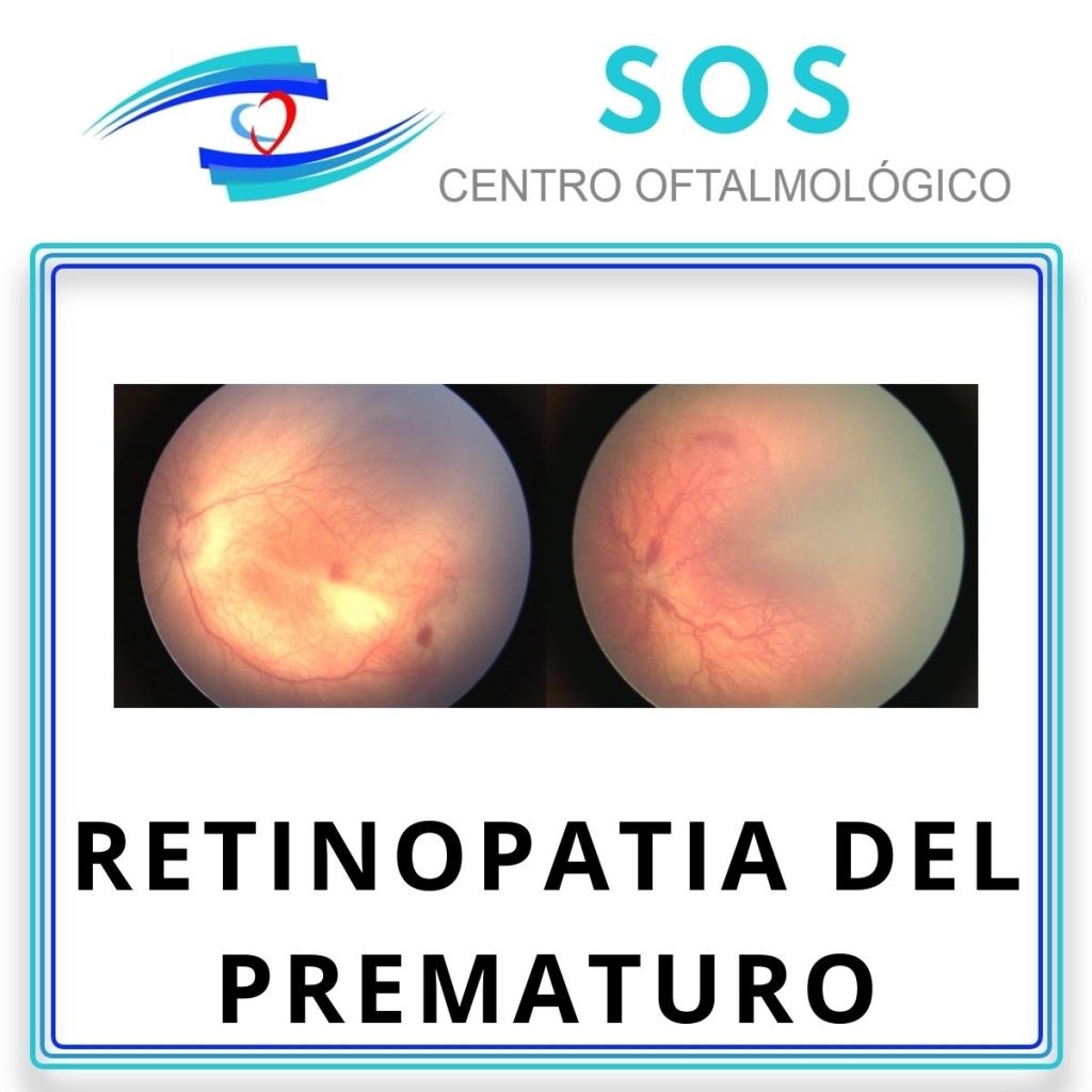 Retinopatía del Prematuro 