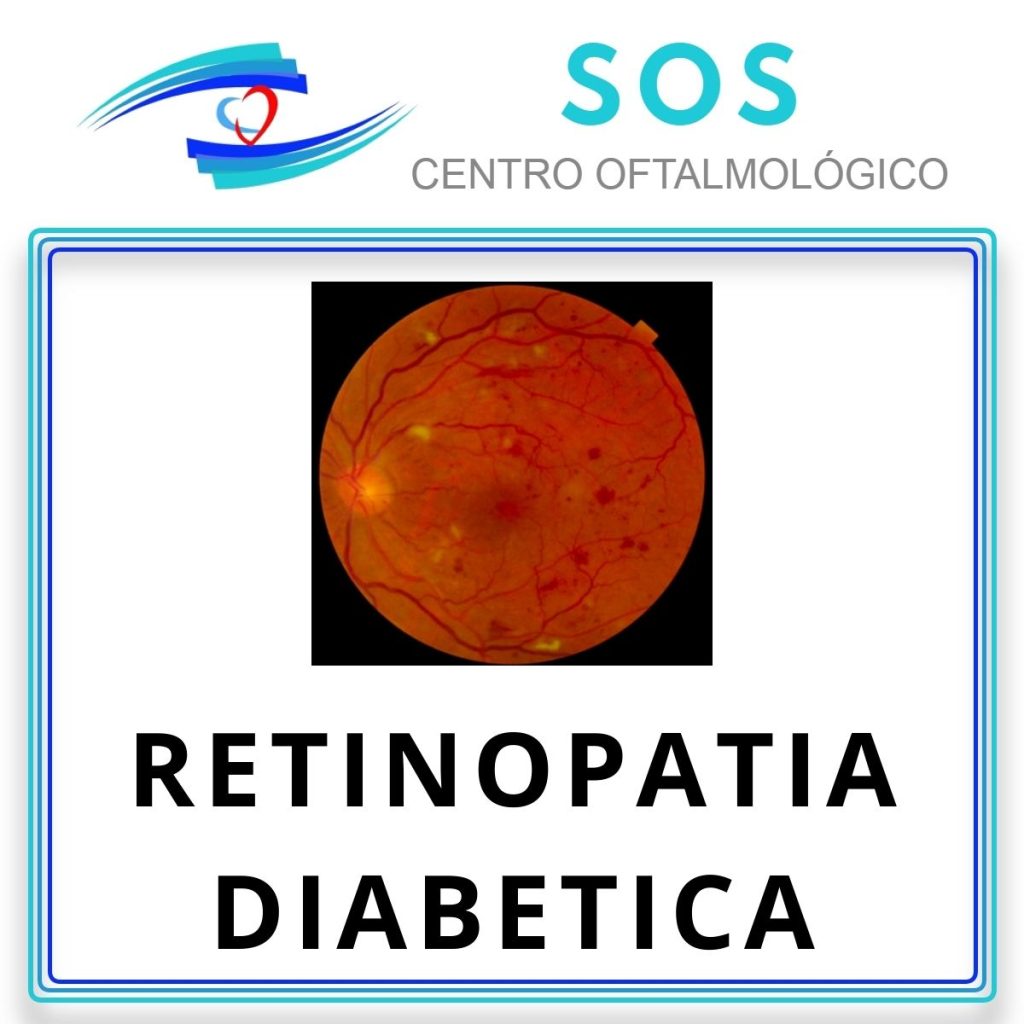 retinopatía Diabética