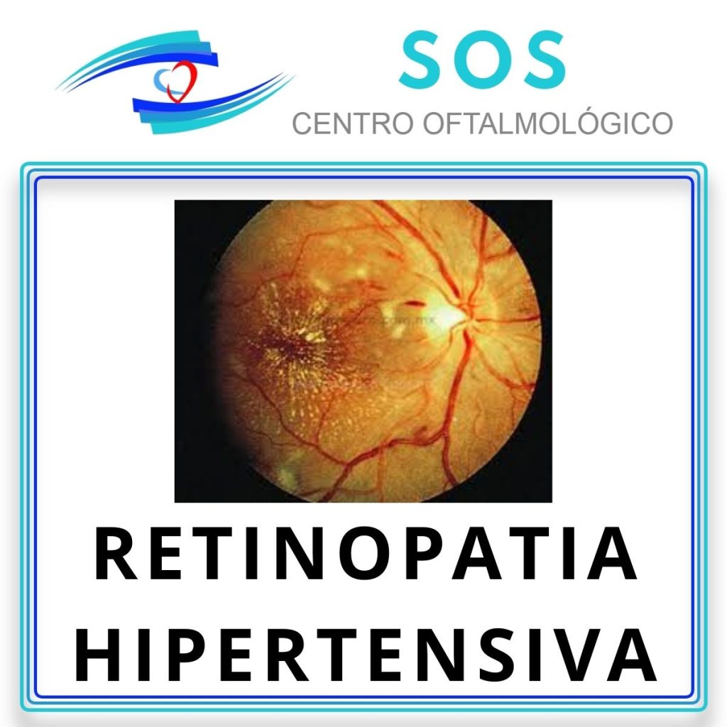 Retinopatía Hipertensiva