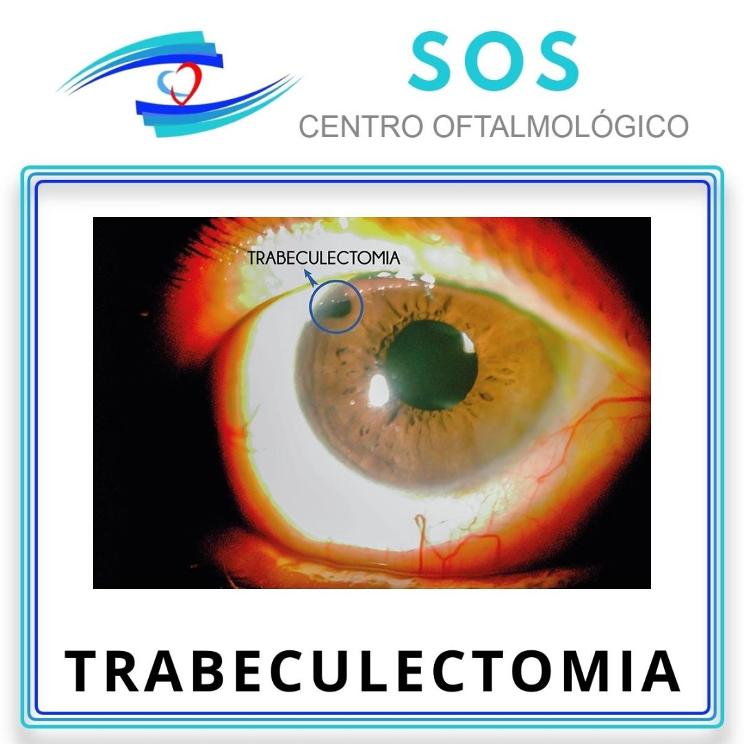 Trabeculoplastia con Láser – Centro Oftalmológico SOS