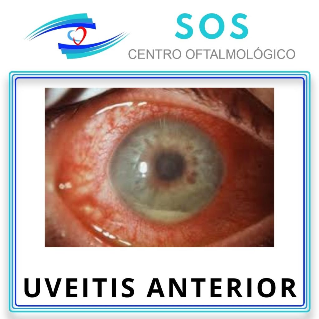 Uveítis Anterior