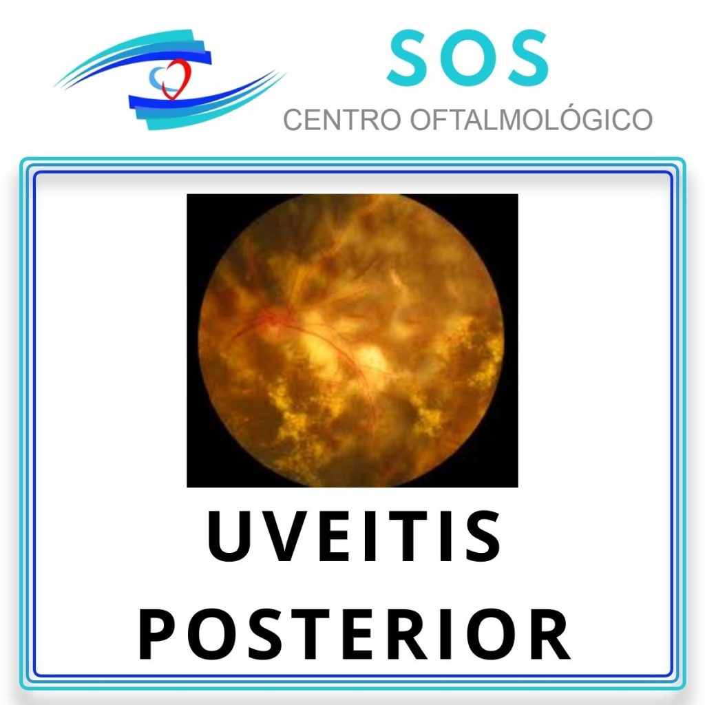 Uveítis Posterior