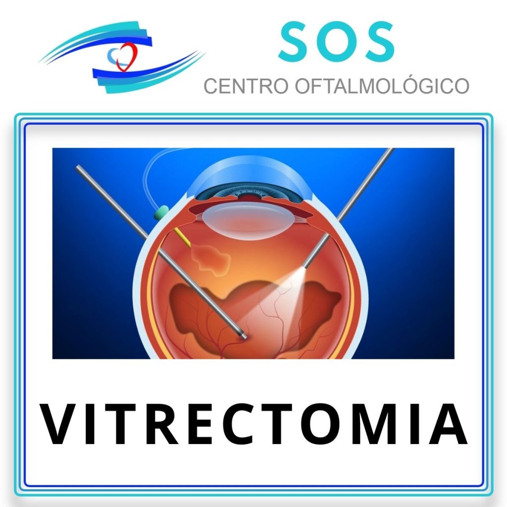 VITRECTOMIA