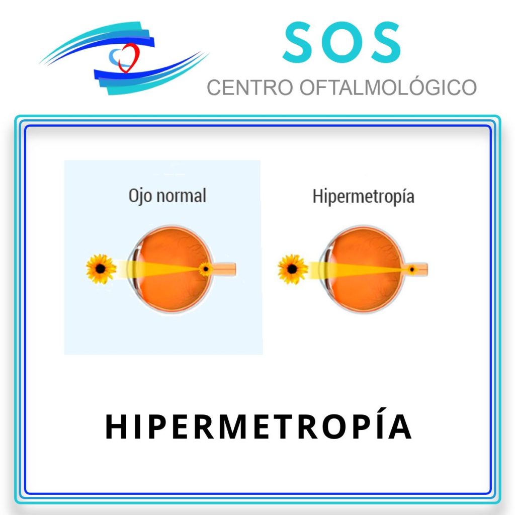 Hipermetropía