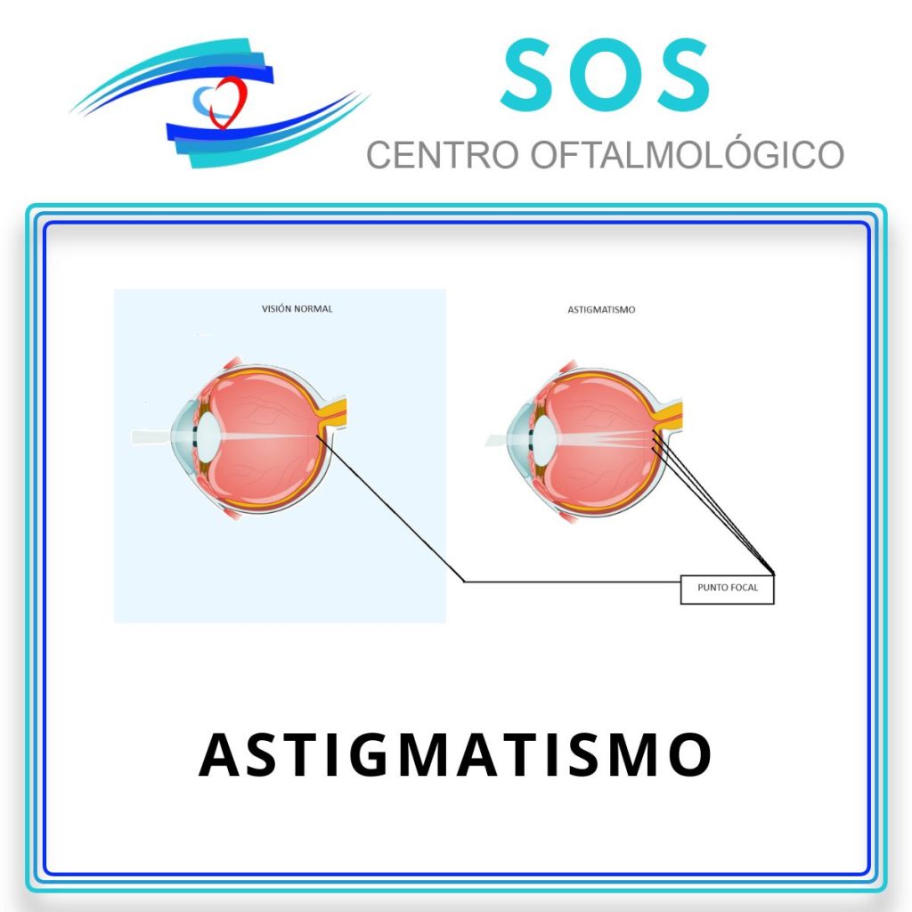 Astigmatismo