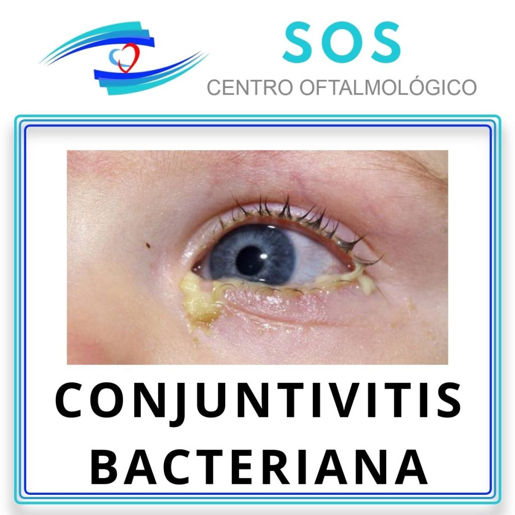 Conjuntivitis bacteriana