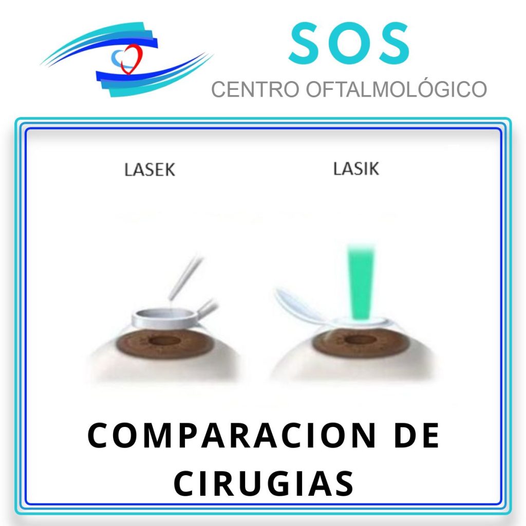 Comparación entre las cirugías Lasik y Lasek