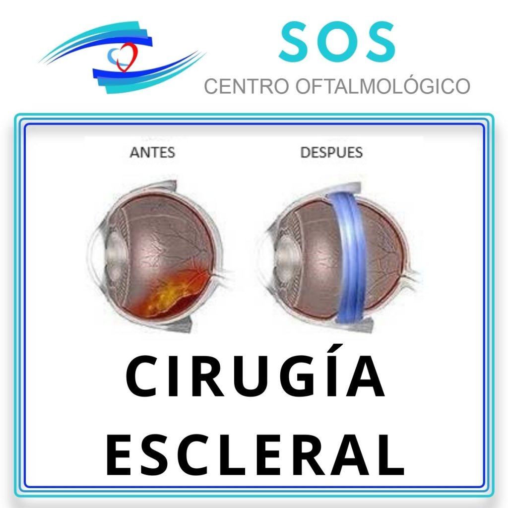 Cirugía escleral