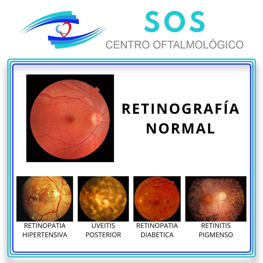 Imagen con varias fotografías de retinografía. la primera es una retina normal, las otras cuatro muestran retinografías alteradas